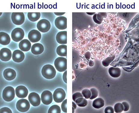 Uric Acid- Both Helpful and Destructive – Learn Why!