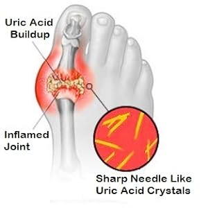 Are you being attacked by Uric Acid?  Stages of Gout…….